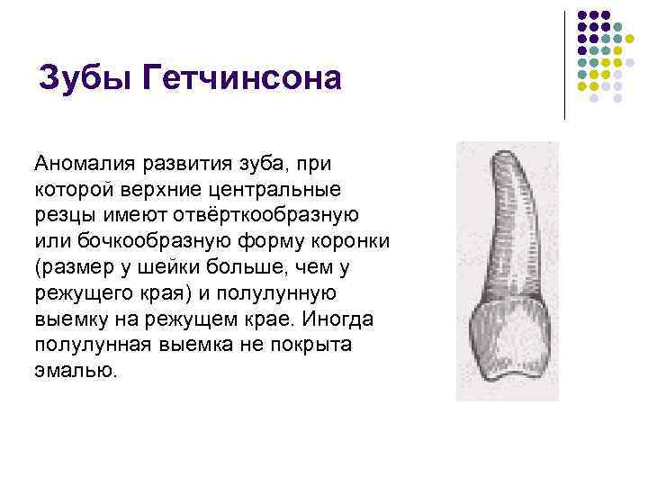 Зубы Гетчинсона Аномалия развития зуба, при которой верхние центральные резцы имеют отвёрткообразную или бочкообразную