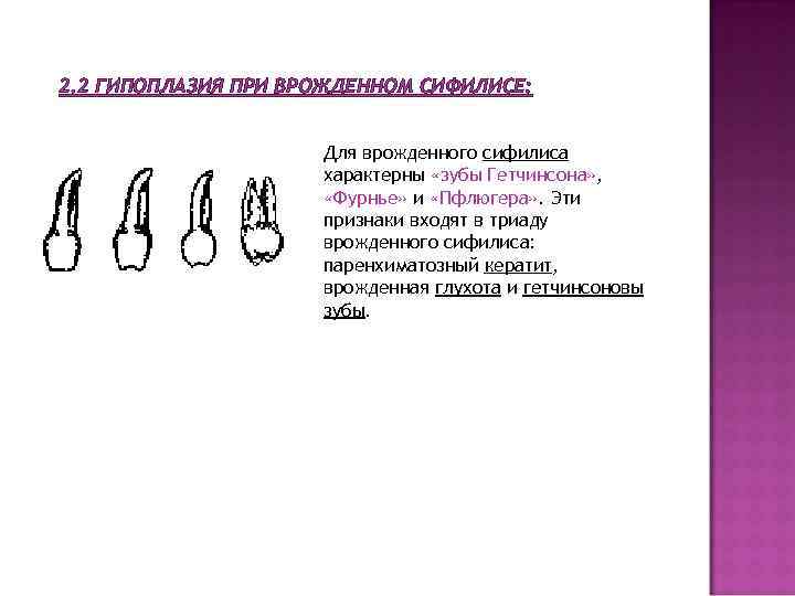 2. 2 ГИПОПЛАЗИЯ ПРИ ВРОЖДЕННОМ СИФИЛИСЕ: Для врожденного сифилиса характерны «зубы Гетчинсона» , «Фурнье»
