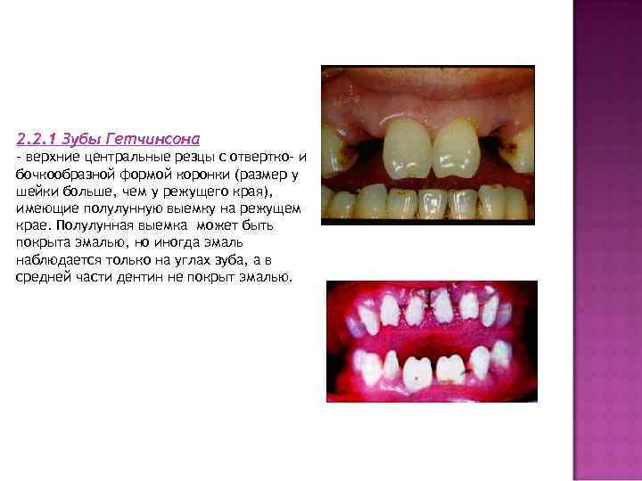 2. 2. 1 Зубы Гетчинсона - верхние центральные резцы с отвертко- и бочкообразной формой