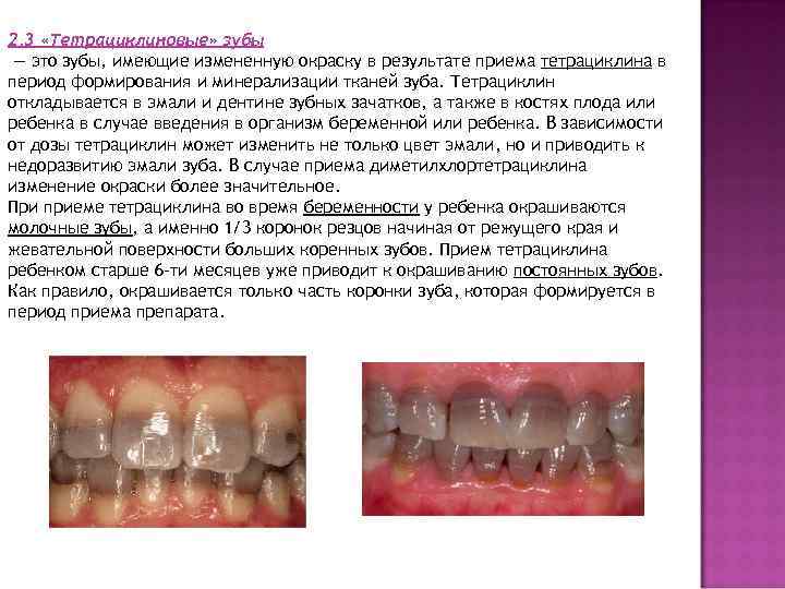 2. 3 «Тетрациклиновые» зубы — это зубы, имеющие измененную окраску в результате приема тетрациклина