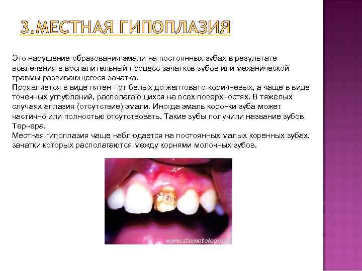 3. МЕСТНАЯ ГИПОПЛАЗИЯ Это нарушение образования эмали на постоянных зубах в результате вовлечения в