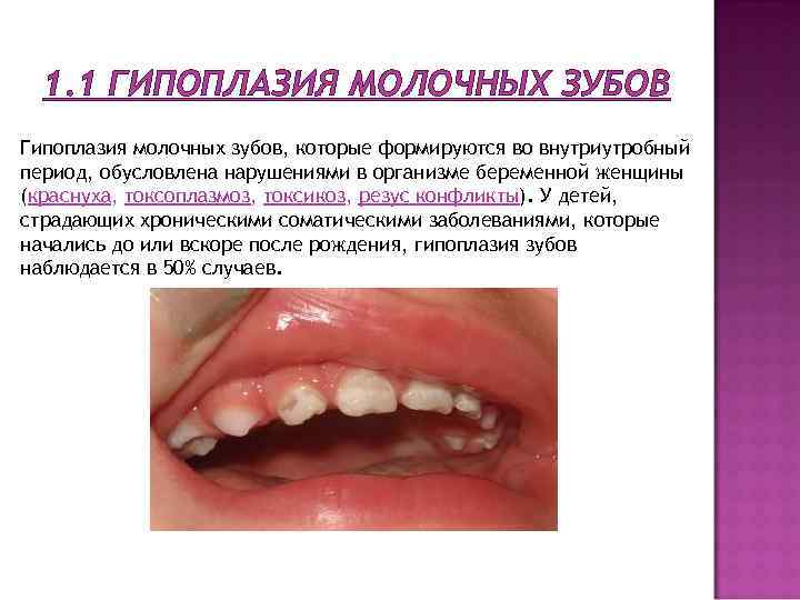 1. 1 ГИПОПЛАЗИЯ МОЛОЧНЫХ ЗУБОВ Гипоплазия молочных зубов, которые формируются во внутриутробный период, обусловлена