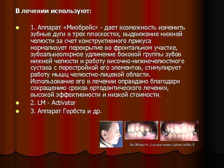 В лечении используют: l l l 1. Аппарат «Миобрейс» - дает возможность изменить зубные