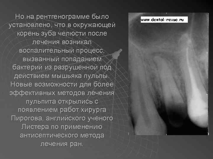 Но на рентгенограмме было установлено, что в окружающей корень зуба челюсти после лечения возникал