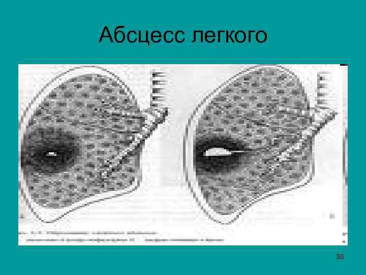 Абсцесс легкого 39 