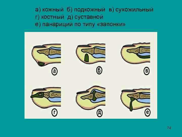 а) кожный б) подкожный в) сухожильный г) костный д) суставной е) панариций по типу