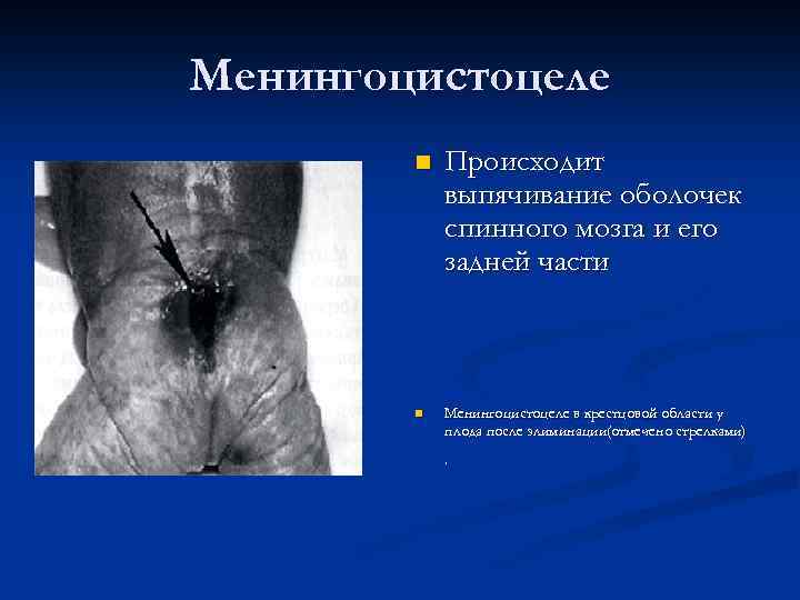 Менингоцистоцеле n n Происходит выпячивание оболочек спинного мозга и его задней части Менингоцистоцеле в