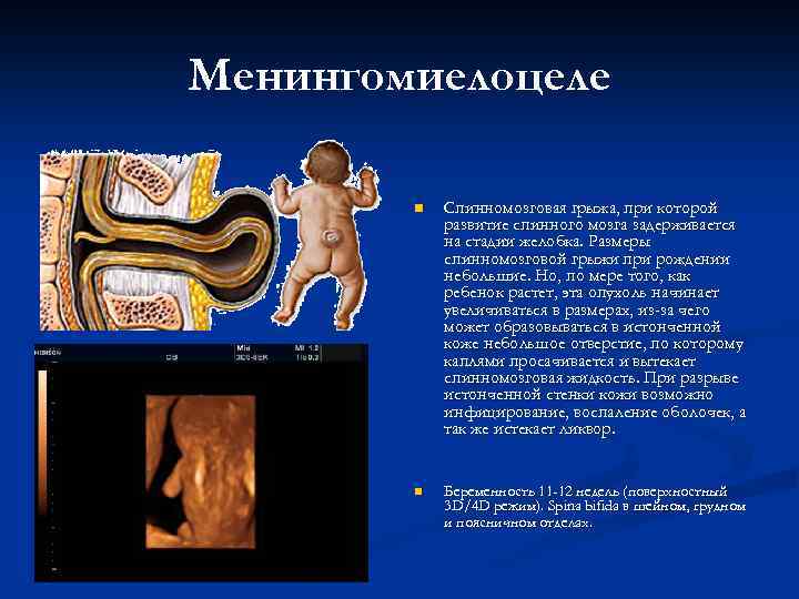 Менингомиелоцеле n Спинномозговая грыжа, при которой развитие спинного мозга задерживается на стадии желобка. Размеры