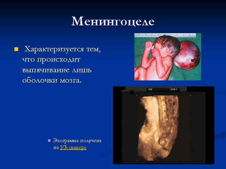 Менингоцеле n Характеризуется тем, что происходит выпячивание лишь оболочки мозга. n Эхограмма получена на