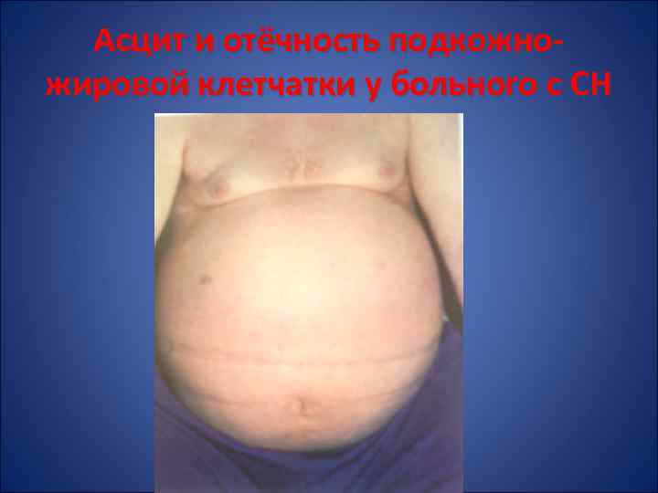 Асцит и отёчность подкожножировой клетчатки у больного с СН 