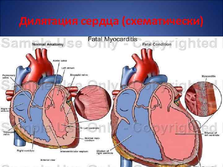 Дилятация сердца (схематически) 