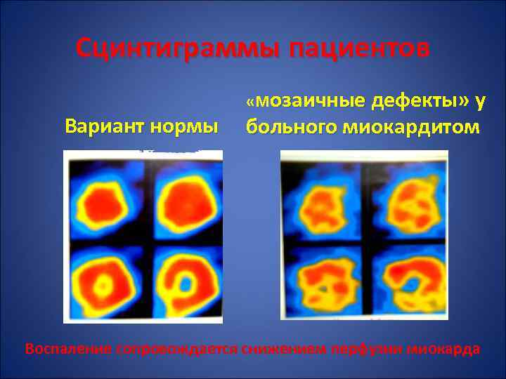 Сцинтиграмма является изображением