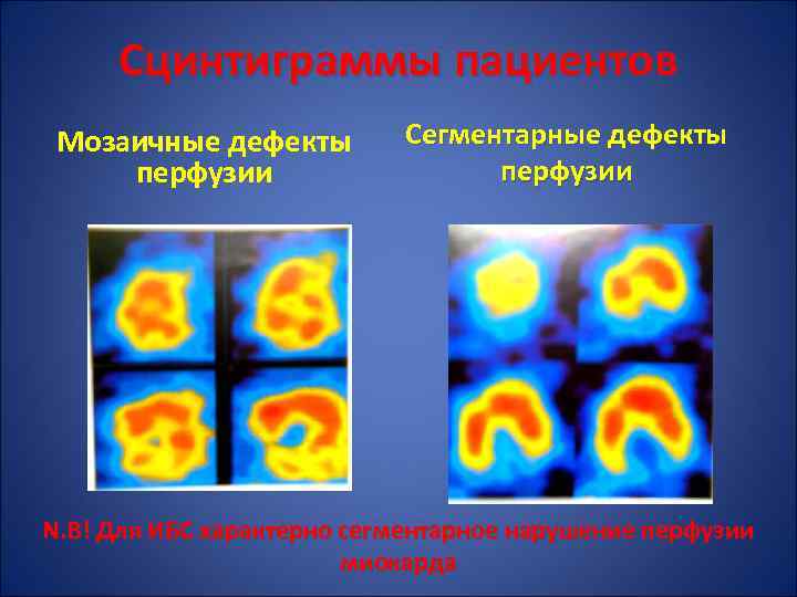 Сцинтиграммы пациентов Мозаичные дефекты перфузии Сегментарные дефекты перфузии N. B! Для ИБС характерно сегментарное