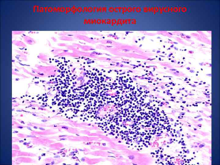 Патоморфология острого вирусного миокардита 