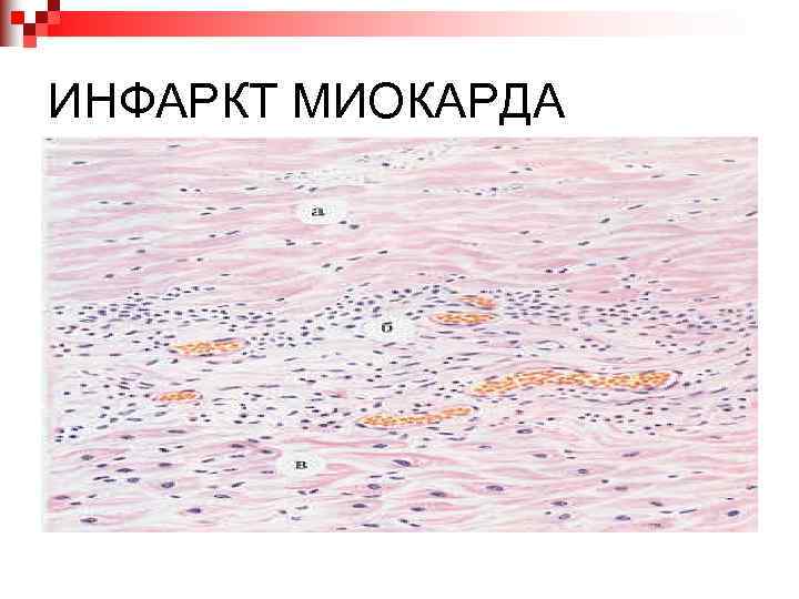 ИНФАРКТ МИОКАРДА 