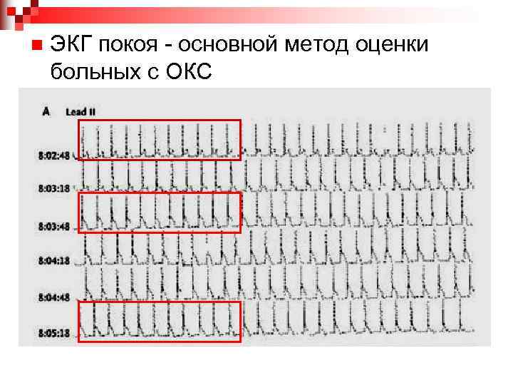 n ЭКГ покоя - основной метод оценки больных с ОКС 