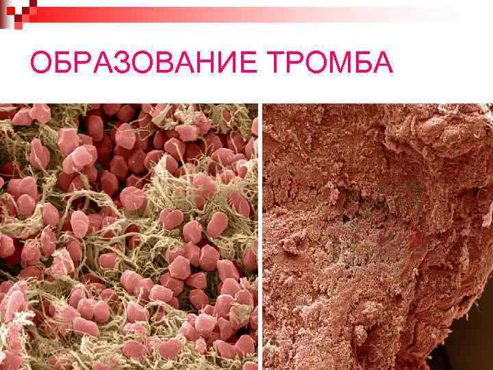 ОБРАЗОВАНИЕ ТРОМБА 