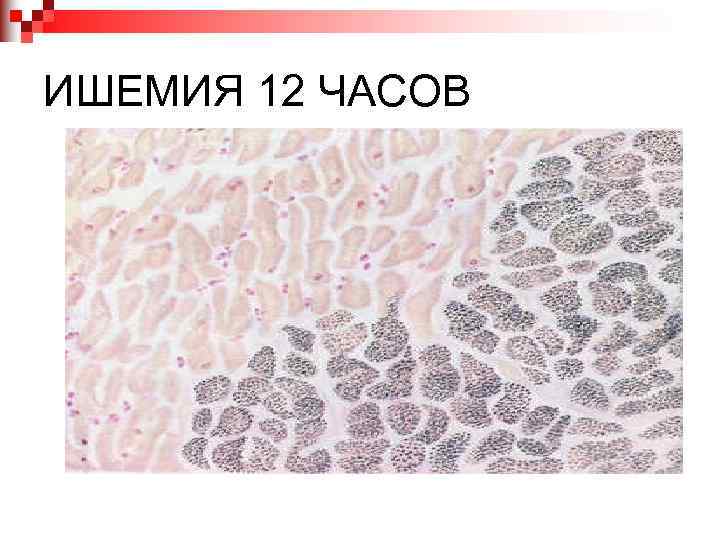 ИШЕМИЯ 12 ЧАСОВ 