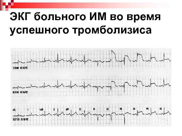 ЭКГ больного ИМ во время успешного тромболизиса 