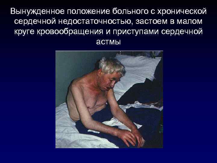 Вынужденное положение больного с хронической сердечной недостаточностью, застоем в малом круге кровообращения и приступами