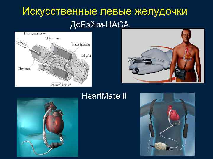 Искусственные левые желудочки Де. Бэйки-НАСА Heart. Mate II 