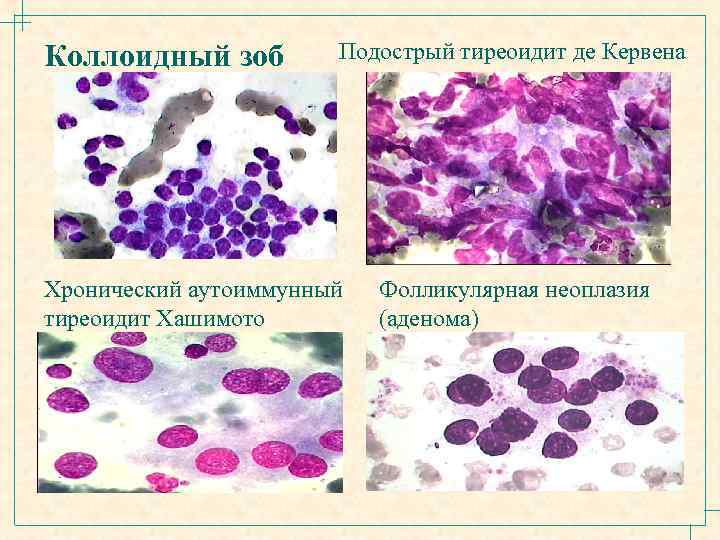 Коллоидный зоб Подострый тиреоидит де Кервена Хронический аутоиммунный тиреоидит Хашимото Фолликулярная неоплазия (аденома) 