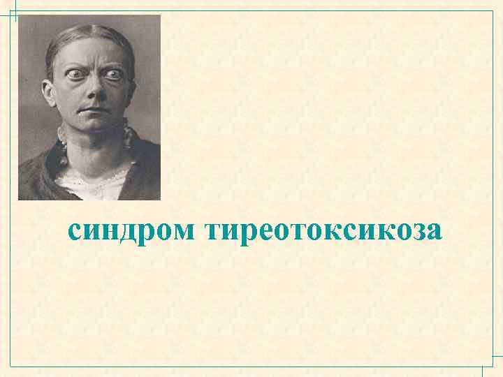 синдром тиреотоксикоза 