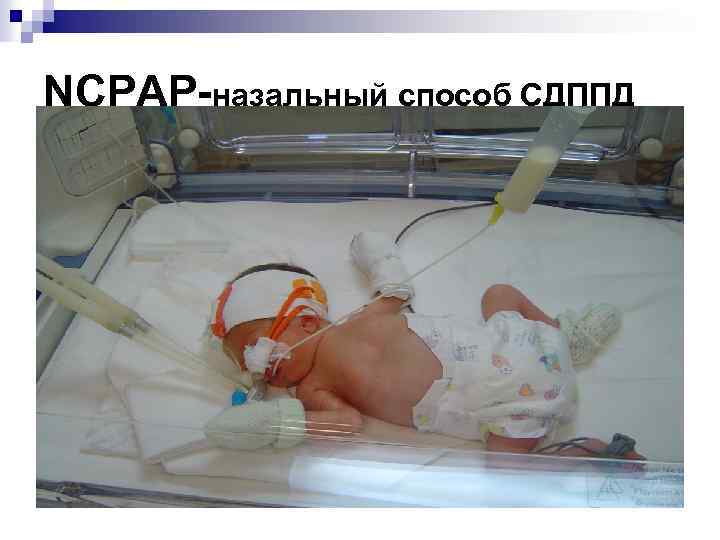 NCPAP-назальный способ СДППД 