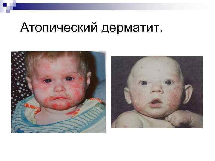  Атопический дерматит. 