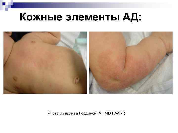Кожные элементы АД: (Фото из архива Гординой. А. , MD FAAR. ) 