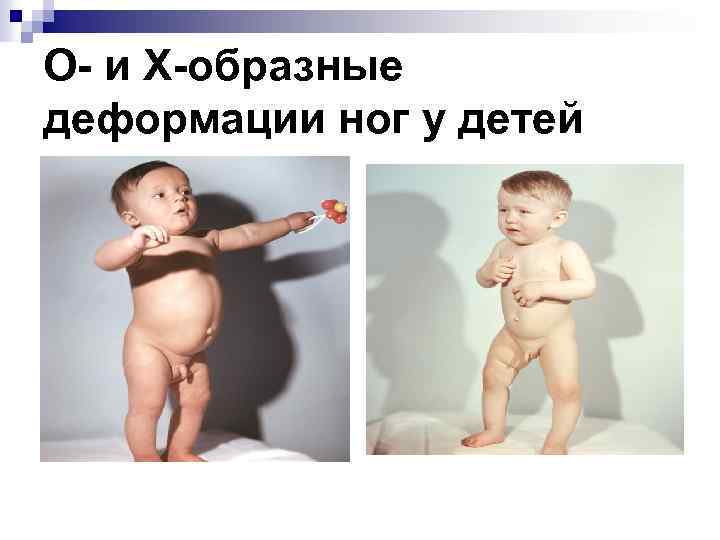 О- и Х-образные деформации ног у детей 