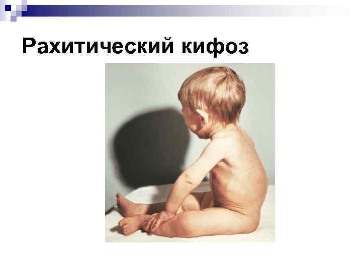 Рахитический кифоз 
