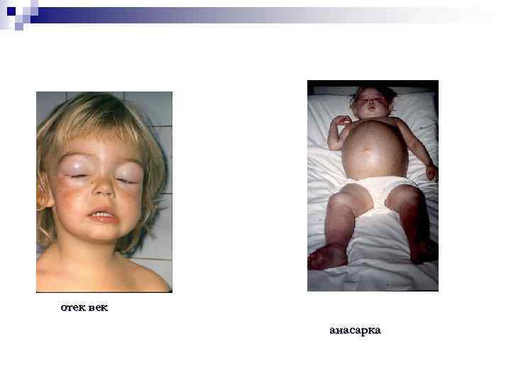отек век анасарка 