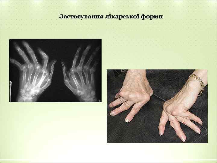 Застосування лікарської форми 