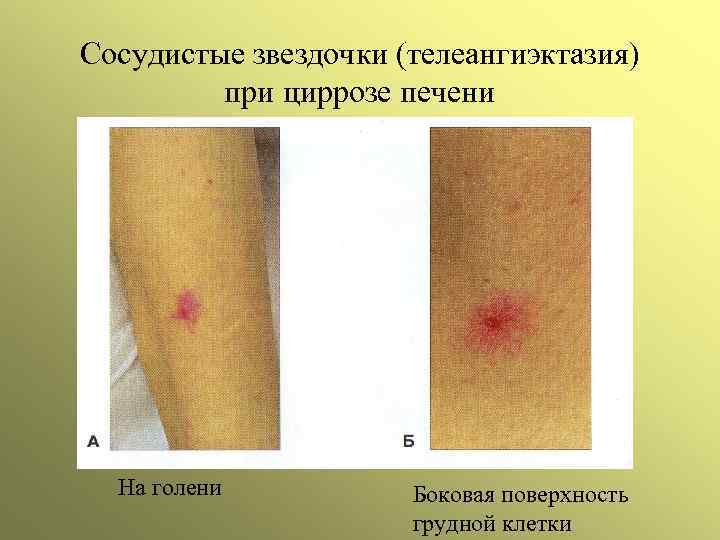 Сосудистые звездочки (телеангиэктазия) при циррозе печени На голени Боковая поверхность грудной клетки 