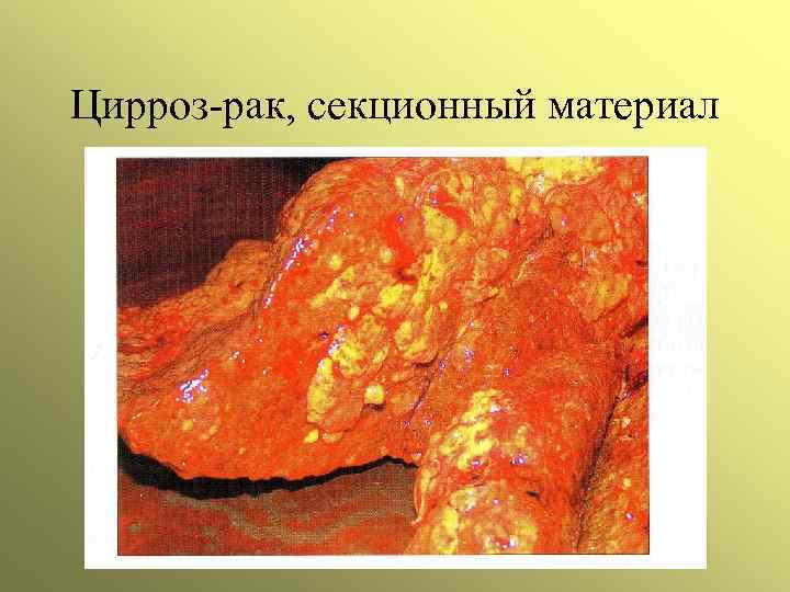 Цирроз-рак, секционный материал 