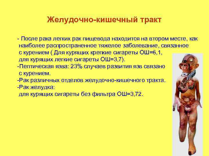 Желудочно-кишечный тракт - После рака легких рак пищевода находится на втором месте, как наиболее