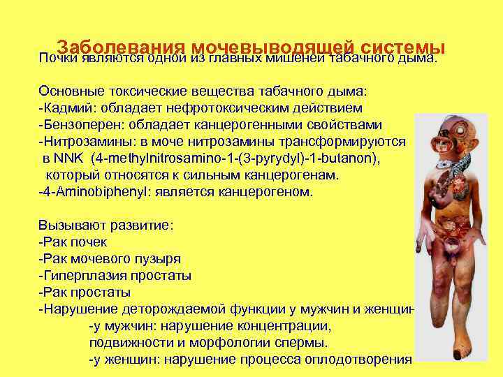 Заболевания мочевыводящей системы Почки являются одной из главных мишеней табачного дыма. Основные токсические вещества