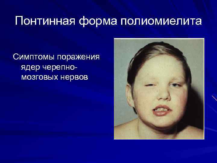 Понтинная форма полиомиелита Симптомы поражения ядер черепномозговых нервов 