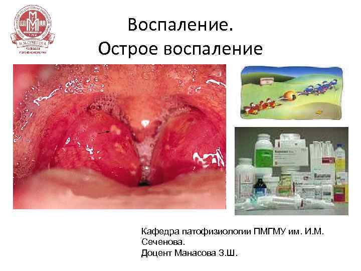 Воспаление. Острое воспаление Кафедра патофизиологии ПМГМУ им. И. М. Сеченова. Доцент Манасова З. Ш.