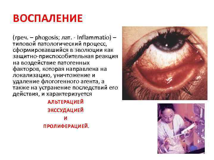 ВОСПАЛЕНИЕ (греч. – phogosis; лат. - Inflammatio) – типовой патологический процесс, сформировавшийся в эволюции