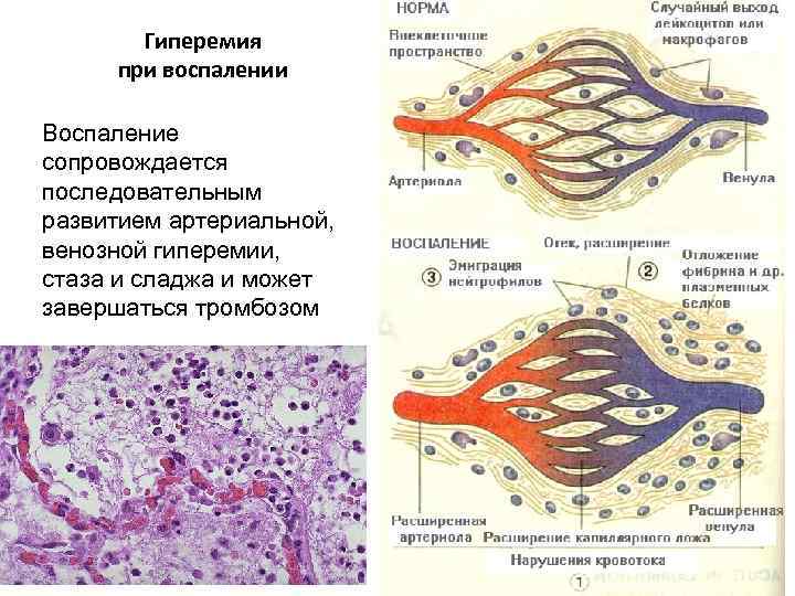Гиперемия при воспалении Воспаление сопровождается последовательным развитием артериальной, венозной гиперемии, стаза и сладжа и