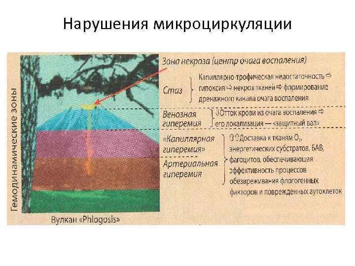 Нарушения микроциркуляции 