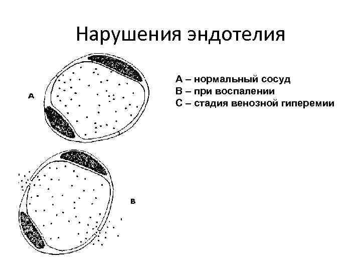 Нарушения эндотелия A – нормальный сосуд В – при воспалении С – стадия венозной