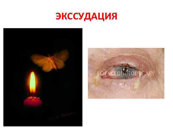 ЭКССУДАЦИЯ 