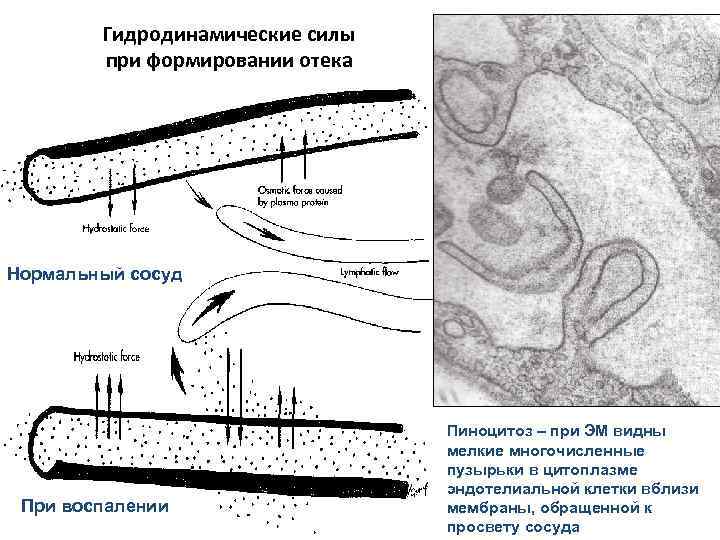 Гидродинамические силы при формировании отека Нормальный сосуд При воспалении Пиноцитоз – при ЭМ видны