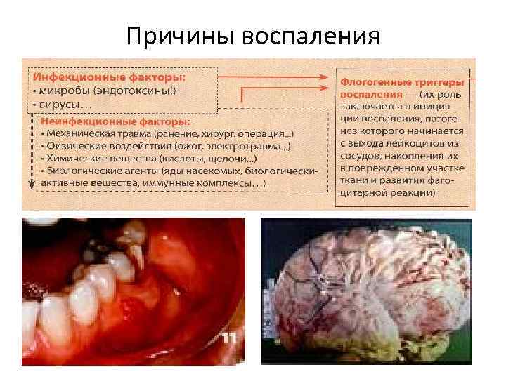 Причины воспаления 