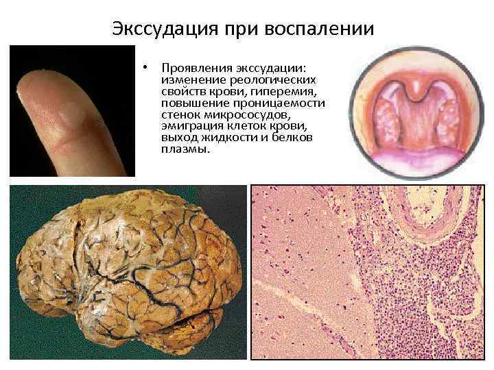 Экссудация при воспалении • Проявления экссудации: изменение реологических свойств крови, гиперемия, повышение проницаемости стенок