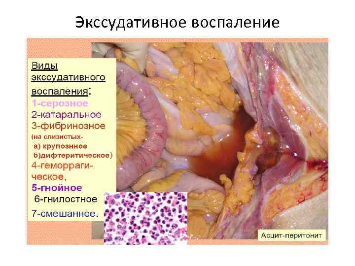 Экссудативное воспаление 