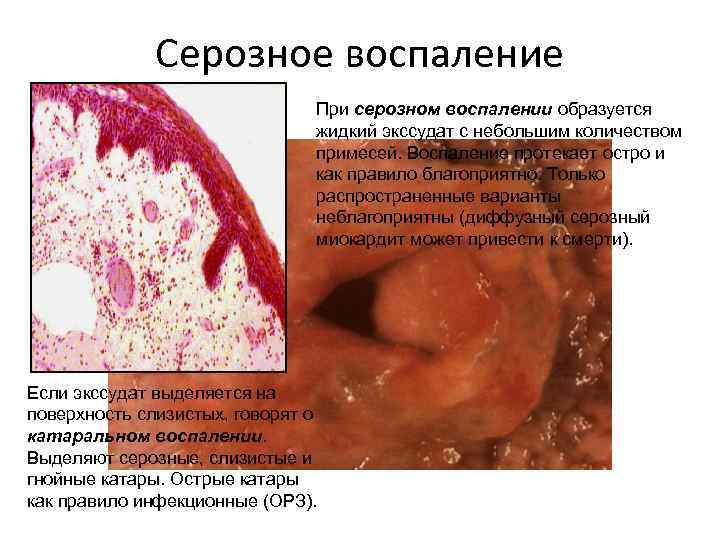 Серозное воспаление При серозном воспалении образуется жидкий экссудат с небольшим количеством примесей. Воспаление протекает